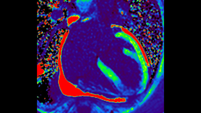 Imaging RM cardiaco completo