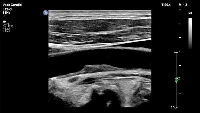 Affidabilit&agrave; diagnostica nell'imaging vascolare