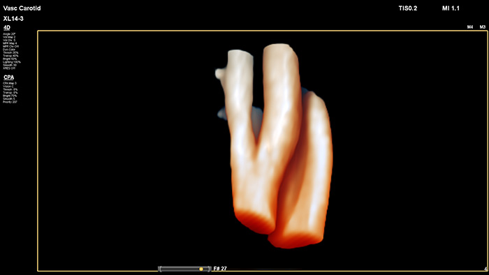Facile valutazione dell'ubicazione spaziale e della composizione della placca e utilizzo dei dati di flusso 3D per valutare la stenosi e la tortuosit&agrave;