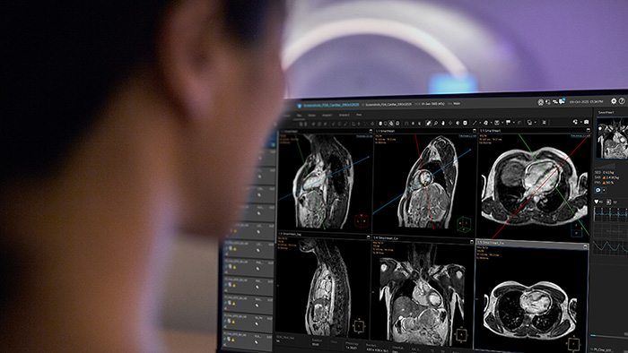 Philips expands access to cardiac MR with FDA 510(k) clearance of AI-Powered SmartHeart